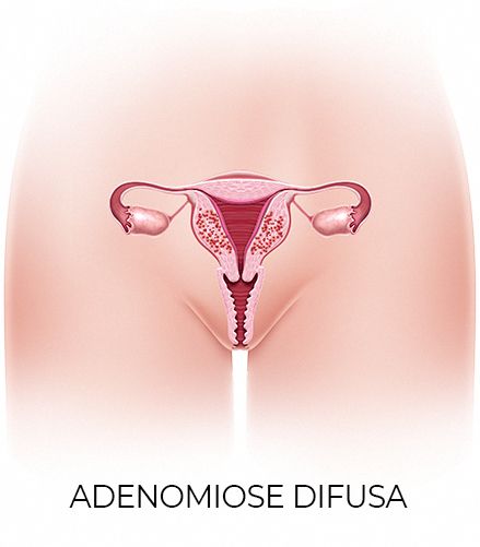 Adenomiose: conheça os sintomas