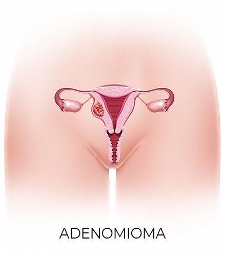 Adenomioma