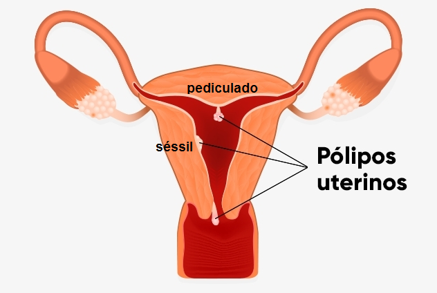 polipos_uterinos
