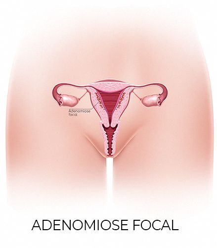 Adenomiose